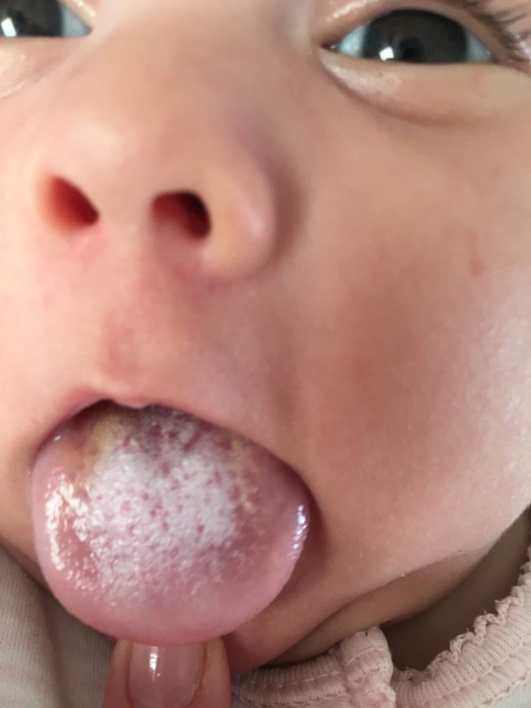 Symptoms and treatment of thrush in children Symptoms and treatment of thrush in children